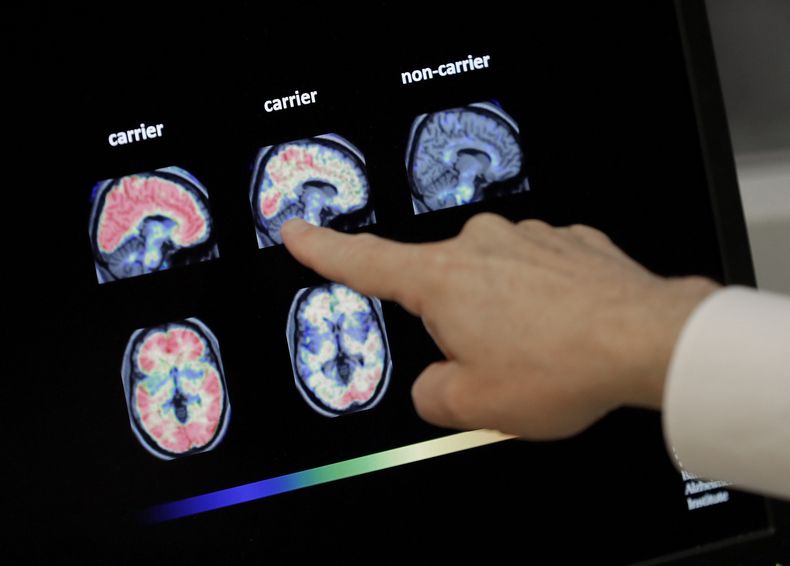 ARCHIVO - Un médico revisa una tomografía del cerebro en el Instituto Banner sobre Alzheimer en Phoenix, el 14 de agosto de 2018. (AP Foto/Matt York, archivo)
