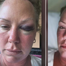 Turista canadiense denuncia brutal agresión en un hotel en Varadero, Cuba