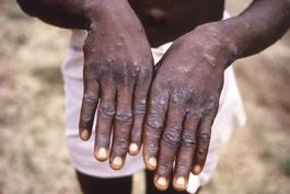 africa dice tratar brote de viruela simica como emergencia