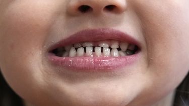 Una niña muestra sus dientes después de un examen dental en Concord, Nueva Hampshire, el miércoles 21 de febrero de 2024. (AP Foto/Robert F. Bukaty, archivo)