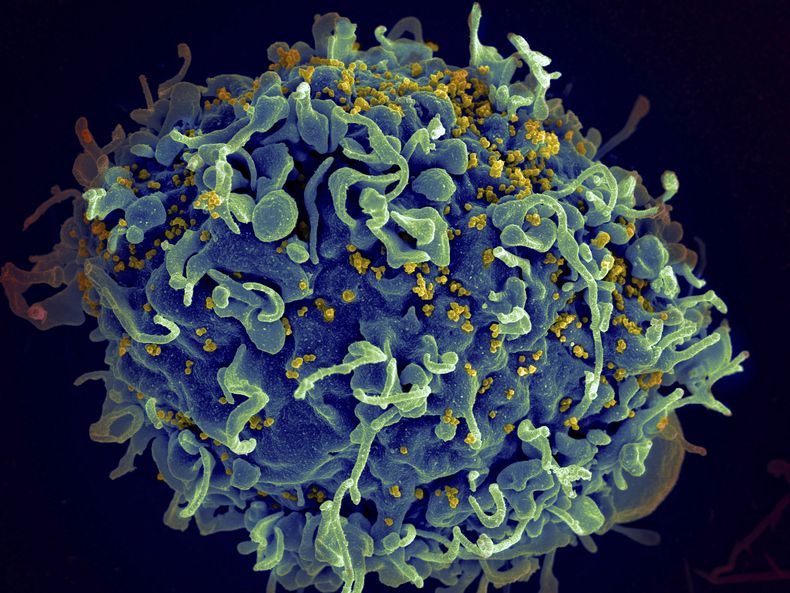 ARCHIVO – En esta imagen coloreada, tomada por un microscopio electrónico y proporcionada por los Institutos Nacionales de Salud de Estados Unidos, se muestra una célula T humana, en azul, siendo atacada por el VIH, el virus que causa el sida, en amarillo. (Seth Pincus, Elizabeth Fischer, Austin Athman/Instituto Nacional de Alergias y Enfermedades Infecciosas/ NIH vía AP, Archivo)