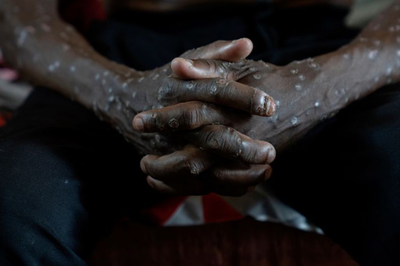 Un hombre con mpox espera recibir tratamiento en el Hospital General de Kamituga en Kivu Sur, República Democrática del Congo, el 4 de septiembre del 2024. (AP foto/Moses Sawasawa)