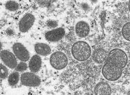 mas de 200 casos de viruela simica en el mundo, dice la oms
