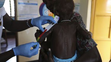 Sunday Achok, de 14 meses, que sufre desnutrición aguda, es medido en el Hospital General Ammusait en Turkana, Kenia el miércoles 4 de junio de 2025. (AP Foto/Andrew Kasuku)
