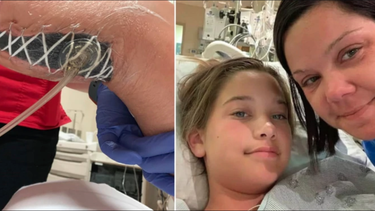 una nina de 12 anos se infecto con una bacteria come carne durante unas vacaciones en florida