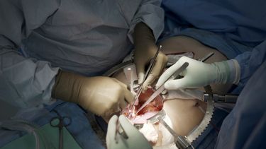 ARCHIVO - Cirujanos del centro médico Langone Health de la Universidad de Nueva York se preparan para trasplantar un riñón de cerdo a un hombre con muerte cerebral, el 14 de julio de 2023, en Nueva York. (AP Foto/Shelby Lum, archivo)