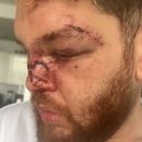 Panama: Hijo de exdiputado le desfigura el rostro a su ex novio, como prueba de amor a su novia
