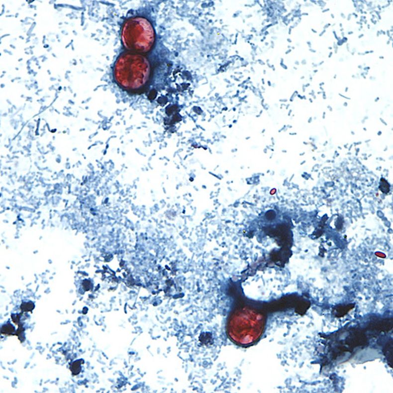 En esta imagen sin fecha, tomada a través de un microscopio y proporcionada por los Centros para el Control y la Prevención de Enfermedades de Estados Unidos (CDC, por sus siglas en inglés), se observan ooquistes de Cyclospora cayetanensis en una muestra fresca de heces preparada con una solución de formalina y teñida con safranina. (CDC vía AP)