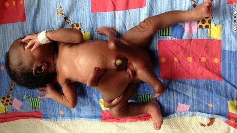 Un bebé con ocho extremidades se recupera tras una operación exitosa.