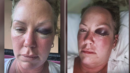turista canadiense denuncia brutal agresion en un hotel en varadero, cuba