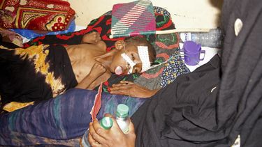 Una mujer atiende a su hijo desnutrido en el hospital Banadir el miércoles 14 de mayo de 2025, en Mogadiscio, Somalia. (AP Foto/Farah Abdi Warsameh)