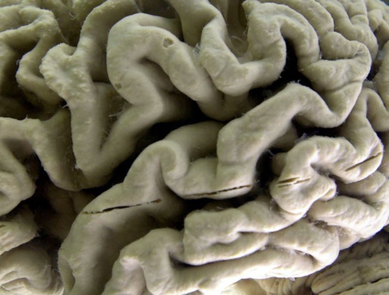 ARCHIVO - Un cerebro humano afectado por la enfermedad de Alzheimer se ve expuesto en el Museo de Neuroanatomía en la Universidad de Buffalo en Buffalo, Nueva York, el 7 de octubre de 2003. (AP Foto/David Duprey, Archivo)