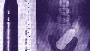 americateve | El Sexo no siempre termina en una felicidad placentera. Hay ciertos casos extraños pero reales de personas que terminaron en el hospital.