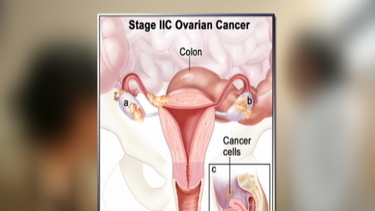 relacionan tratamiento para menopausia con cancer de ovarios