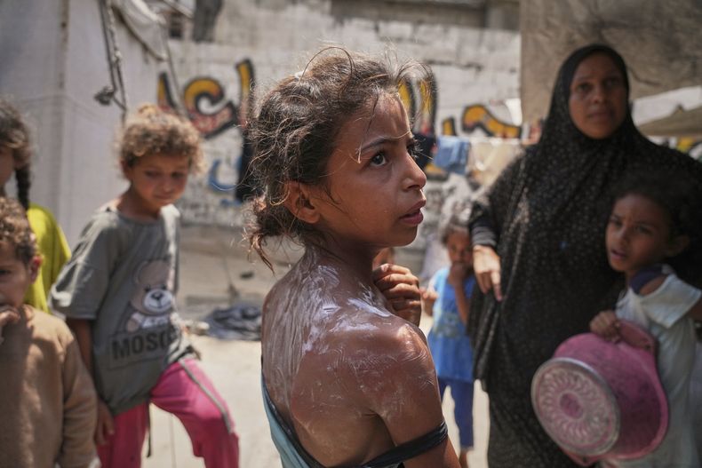 Rital Abu Jari, una niña de 9 años, permanece de pie después de recibir crema para aliviar las quemaduras en espalda y hombro que sufrió cuando intentaba conseguir comida caliente donada en una cocina comunitaria en la ciudad de Gaza, el martes 10 de junio de 2025. (AP Foto/Jehad Alshrafi)