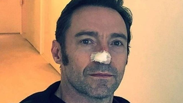 que es el carcinoma basocelular, el cancer de piel que sufre el actor hugh jackman
