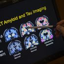 ARCHIVO - Un médico señala imágenes de un escáner cerebral dentro de un estudio sobre el Alzheimer en el hospital de la Universidad de Georgetown, el martes 19 de mayo de 2015 en Washington. (AP Foto/Evan Vucci, Achivo)