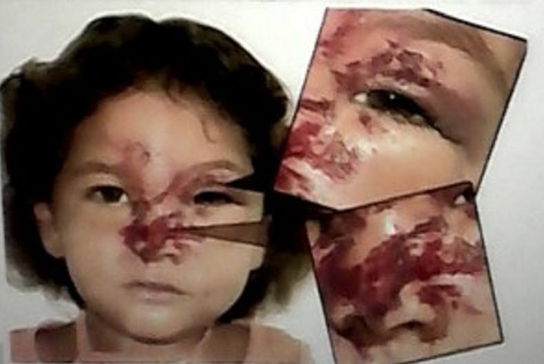 El abuelo de la víctima no está de acuerdo y dio la voz a la prensa independiente. La pequeña tuvo que ir al quirófano