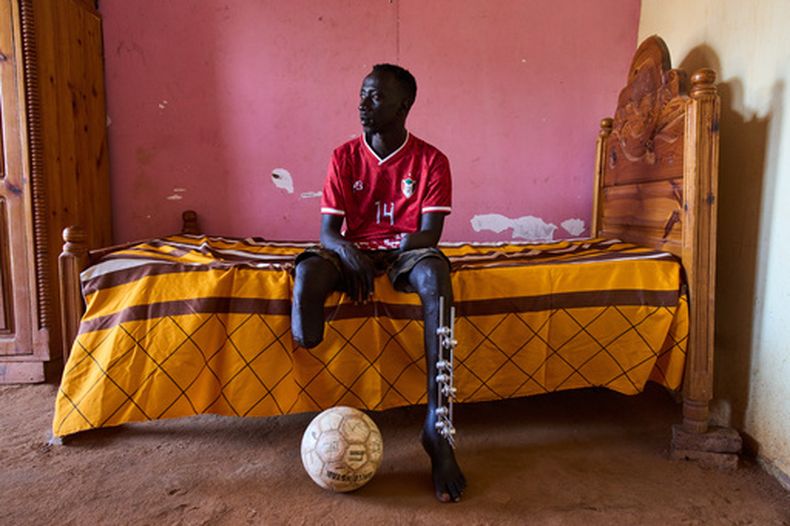 Omer al-Toum, de 33 años, que perdió una pierna y un brazo por la explosión de un artefacto, en su recámara en Bahri, en las afueras de Jartum, el jueves 23 de abril de 2026. (AP Foto/Bernat Armangue)