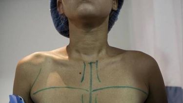 En Venezuela ahora faltan implantes mamarios