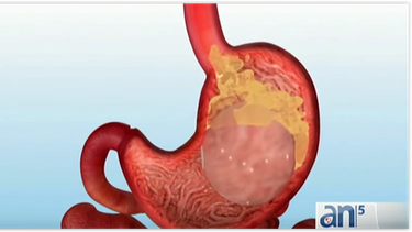fda aprueba globo gastrico para bajar de peso