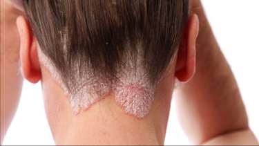 por que cientos de miles de personas con psoriasis siguen sufriendo en silencio
