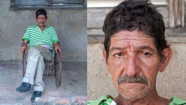 paciente de cancer en cuba tienen que usar jabas a falta de bolsa de colostomia