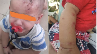 La sarna sigue extendiéndose en Cuba y se ceba en los cuerpos de los bebés