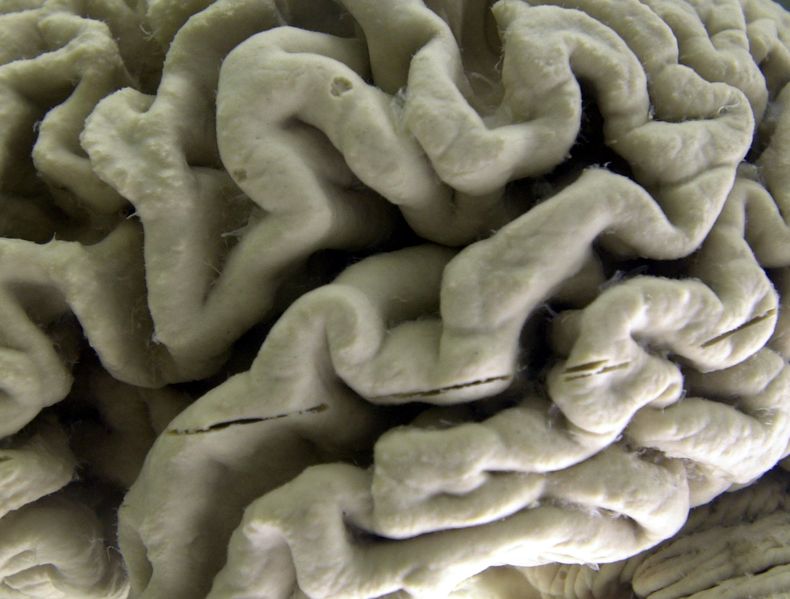 AMN-MED_ALZHEIMER-ESTILO_DE_VIDA-0.jpg