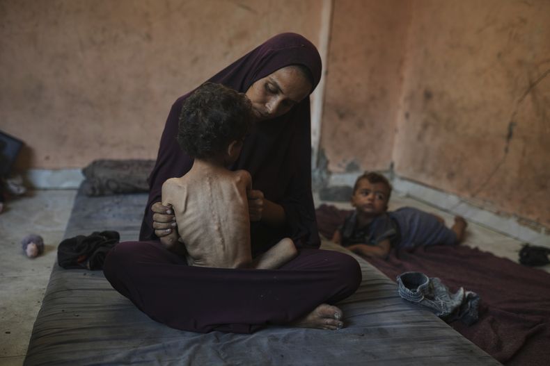 Naima Abu Ful posa para una foto con su hijo Yazan, de 2 años, quien padece desnutrición aguda, el miércoles 23 de julio de 2025, en el campamento de refugiados Shati, en Ciudad de Gaza. (AP Foto/Jehad Alshrafi)
