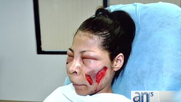 intervienen en miami a victima de tratamiento de belleza ilegal