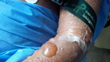 Extraña enfermedad e ignorancia oficial en Venezuela