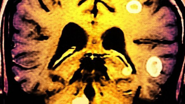 tuberculosis en el cerebro: el dolor es tan fuerte que me dan ganas de cortarme la cabeza