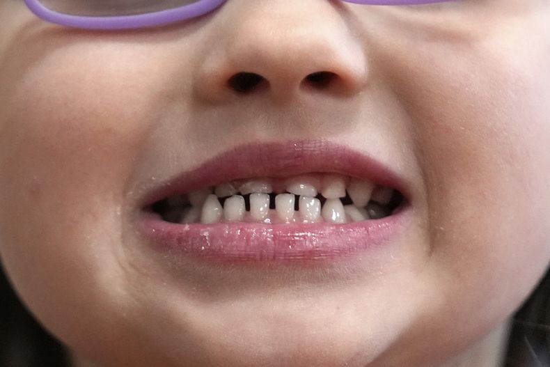 Una niña muestra sus dientes después de un examen dental en Concord, Nueva Hampshire, el miércoles 21 de febrero de 2024. (AP Foto/Robert F. Bukaty, archivo)