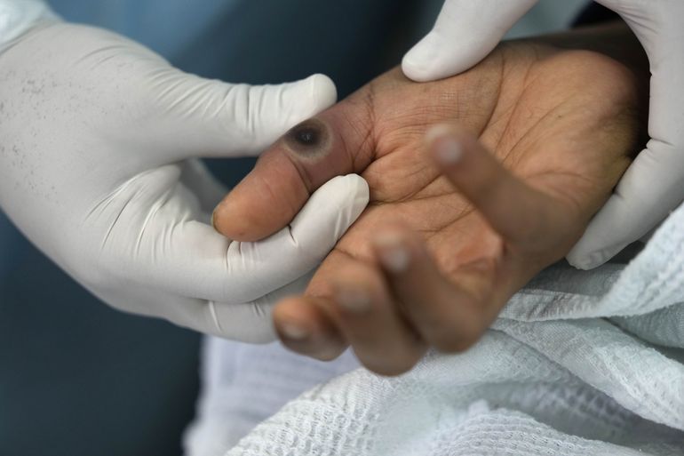 Hospital de Perú lucha contra rápido brote de viruela símica