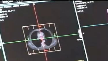 americateve | Este tipo de cáncer se cobra cada año muchas vidas.