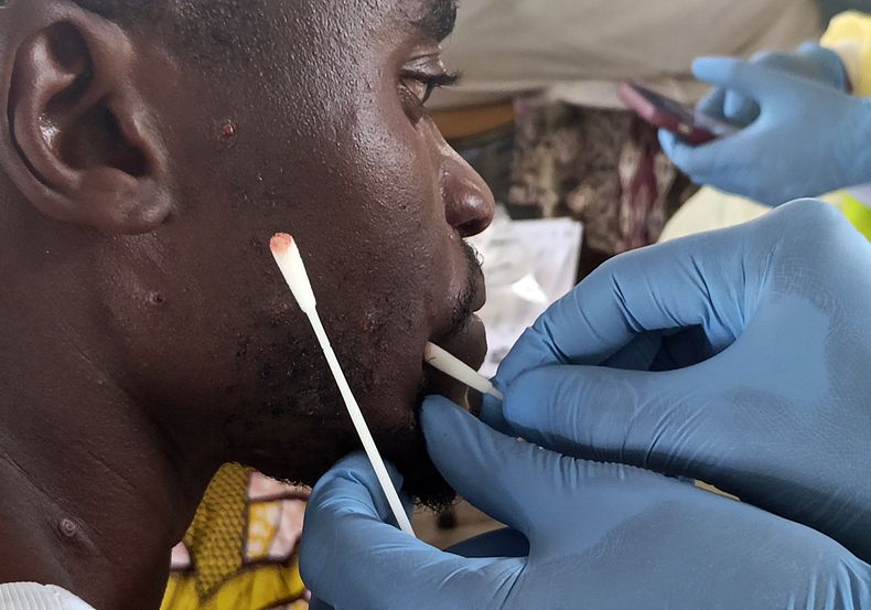 Patrick Bahati recibe tratamiento para el mpox en el hospital Miti Murhesa, a unos 25 kilómetros (5,5 millas) de Bukavu, República Democrática del Congo, el jueves 6 de marzo de 2025. (AP Foto/Janvier Barhahiga)