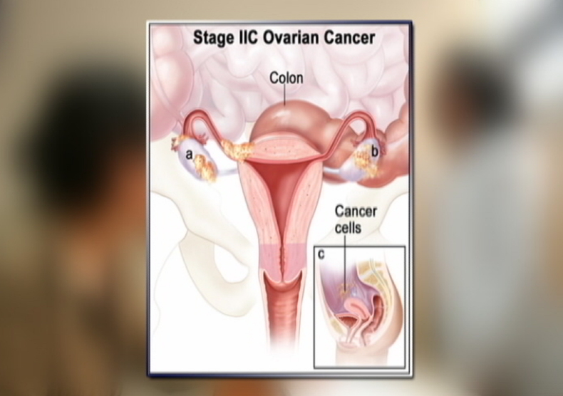 cancer ovario.png