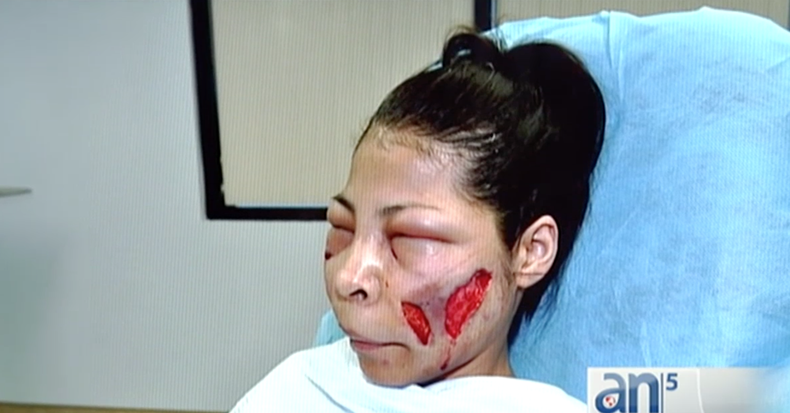 mujer operada en la cara
