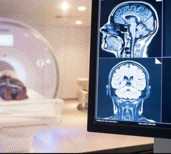 ¿Cuál es el efecto cognitivo del COVID? El cerebro de algunos pacientes podría envejecer hasta 10 años