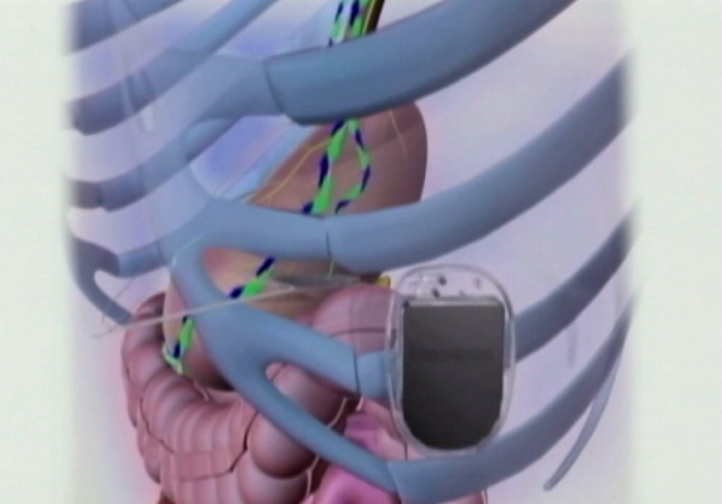 DISPOSITIVO OBESIDAD.png