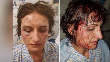 el desgarrador testimonio de una mujer atacada a martillazos por su exesposo en inglaterra