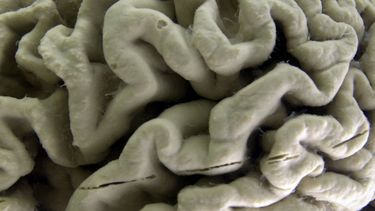 Cambios en estilo de vida podrían evitar mal de Alzheimer