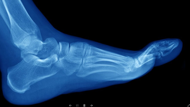 ¿que son las fracturas de huesos por estres y quienes son mas propensos a sufrirlas?