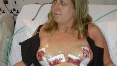 francia: 1.600 mujeres con boobies pip seran indemnizadas