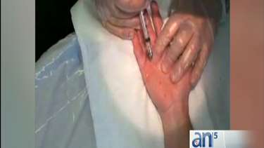 vivir mejor: botox para tratar la sudoracion excesiva de manos y axilas