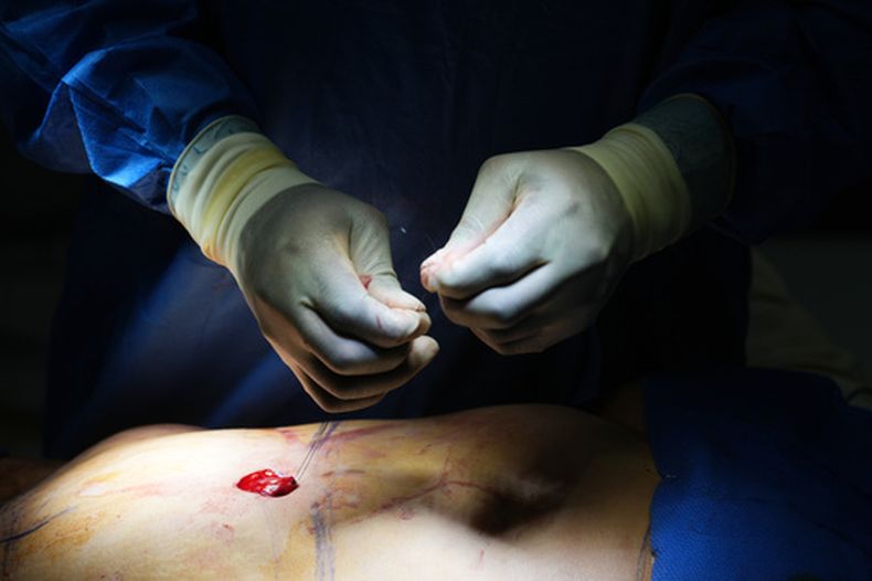 El cirujano plástico Michael Obeng realiza una cirugía de reconstrucción de ombligo después de una abdominoplastia en un centro quirúrgico de Beverly Hills, California, el jueves 5 de febrero de 2026. (AP Foto/Damian Dovarganes)