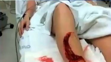 americateve | El más reciente caso de ataque de tiburón vuelve a llamar la atención sobre la Florida, una zona donde se producen con mucha frecuencia estos incidentes.