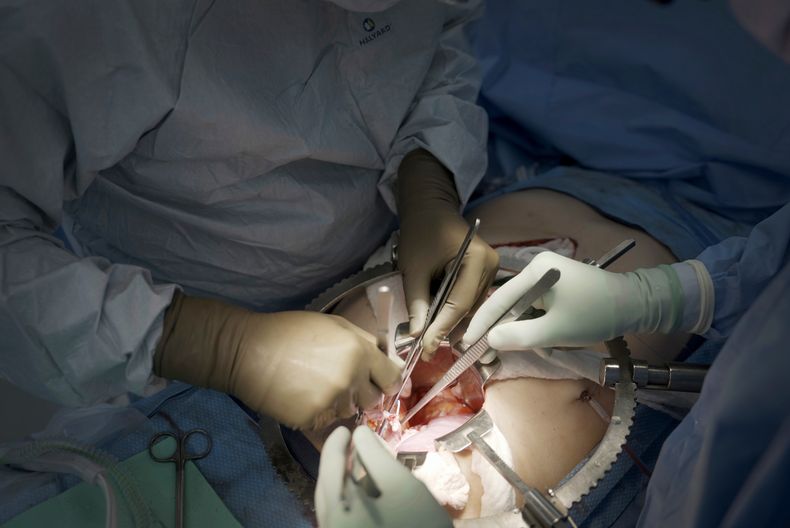 ARCHIVO - Cirujanos del centro médico Langone Health de la Universidad de Nueva York se preparan para trasplantar un riñón de cerdo a un hombre con muerte cerebral, el 14 de julio de 2023, en Nueva York. (AP Foto/Shelby Lum, archivo)