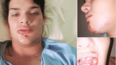 a botellazos le destrozan la cara a joven gay cubano